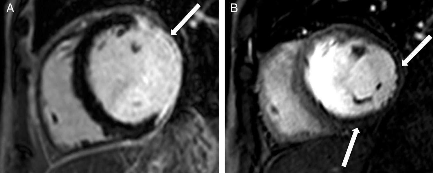 Cardiac MRI Εικόνες από καρδιακό MRI.