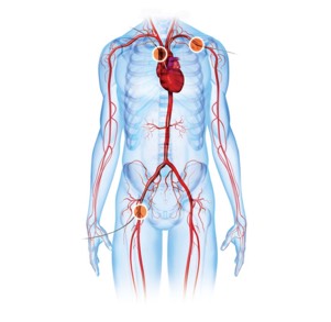 21 FR 18 FR Subclavian Direct Aortic Improved