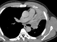 NCCN Χειρ/κής -5 Για Όγκους T3 & T4 με επέκταση κατά συνέχεια ιστού απαιτείται συν εκτομή en bloc των διηθημένων δομών με αρν( ) όρια.