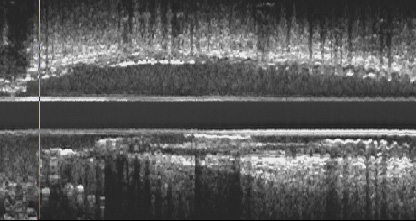 Μελέτη με IVUS σε διχασμούς αγγείων Υπερπλασία 1,5% του stent στον κυρίως και