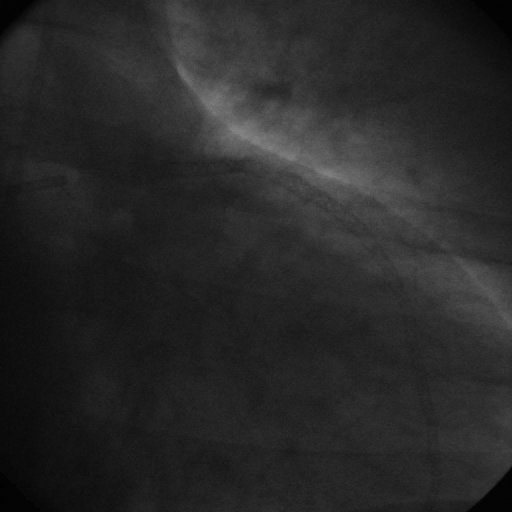 Θρόμβωση μετά από εμφύτευση πολλαπλών Cypher stent