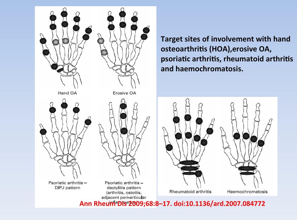 arthriys, rheumatoid arthriys and