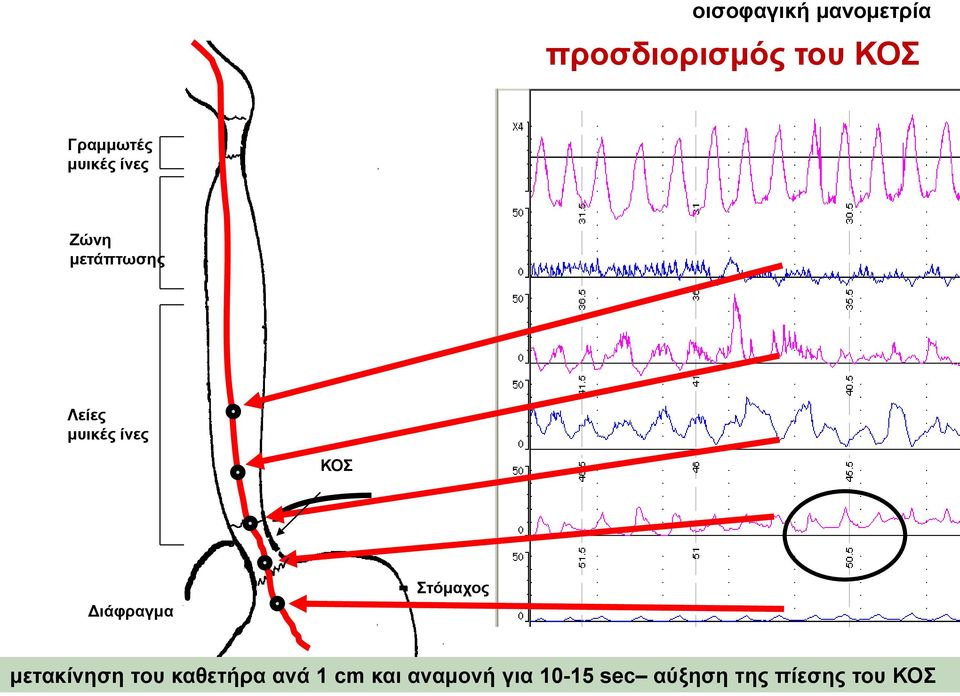 Δηάθξαγκα Σηόκαρνο κεηαθίλεζε ηνπ θαζεηήξα αλά