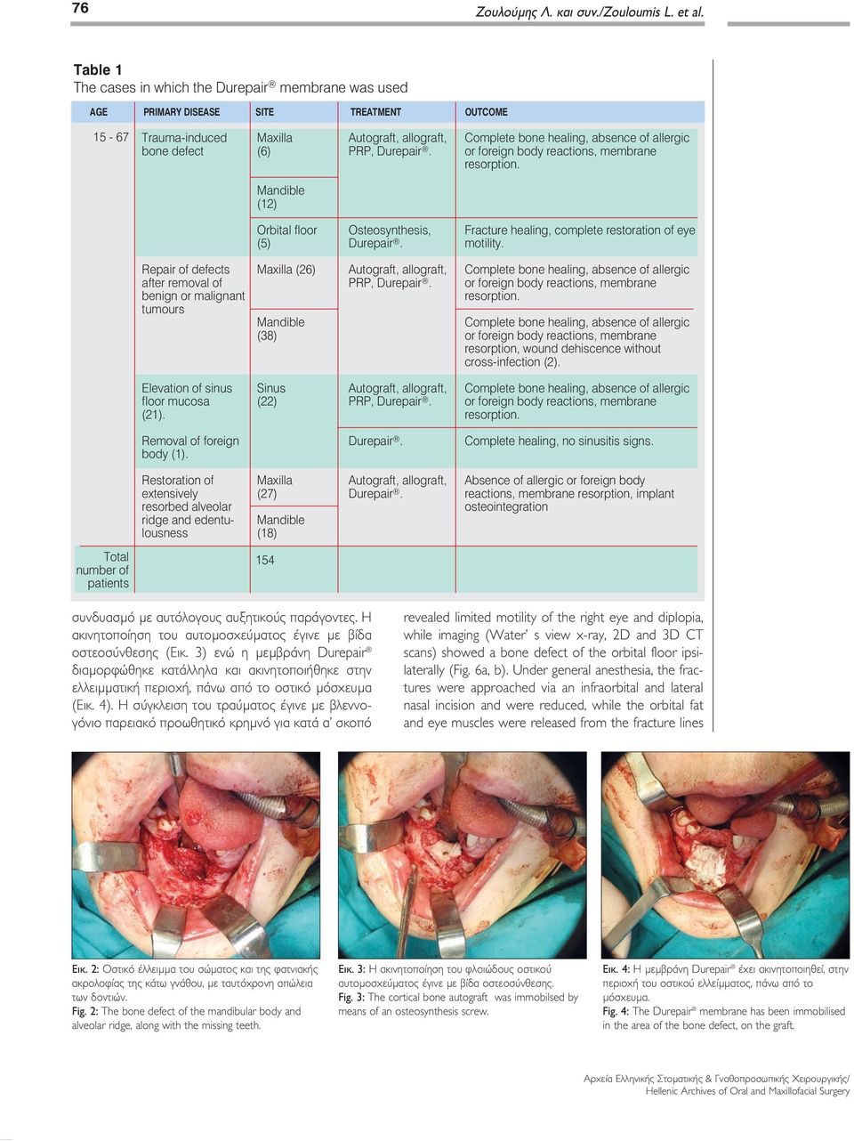 absence of allergic or foreign body reactions, membrane resorption. Mandible (12) Orbital floor (5) Osteosynthesis, Fracture healing, complete restoration of eye motility.