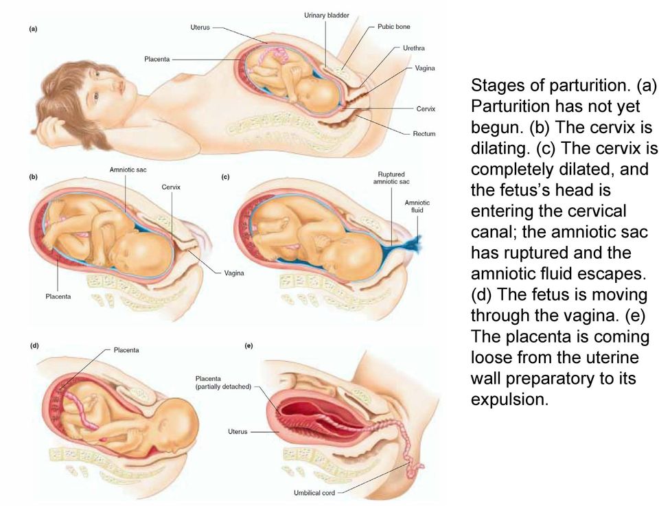 the amniotic sac has ruptured and the amniotic fluid escapes.