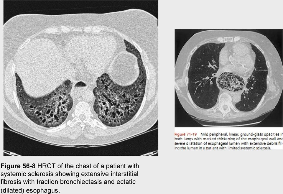 extensive interstitial fibrosis with