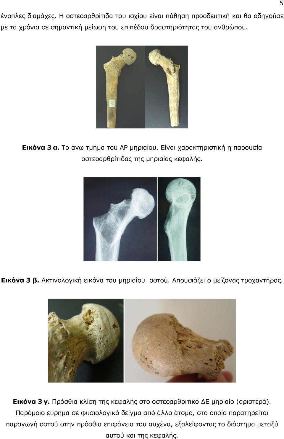 5 Εικόνα 3 α. Το άνω τμήμα του ΑΡ μηριαίου. Είναι χαρακτηριστική η παρουσία οστεοαρθρίτιδας της μηριαίας κεφαλής. Εικόνα 3 β.