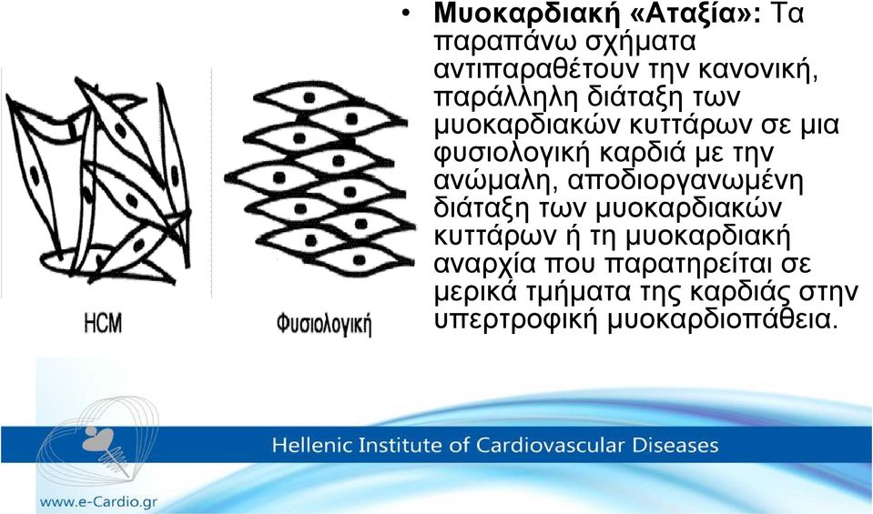 ανώµαλη, αποδιοργανωµένη διάταξη των µυοκαρδιακών κυττάρων ή τη µυοκαρδιακή