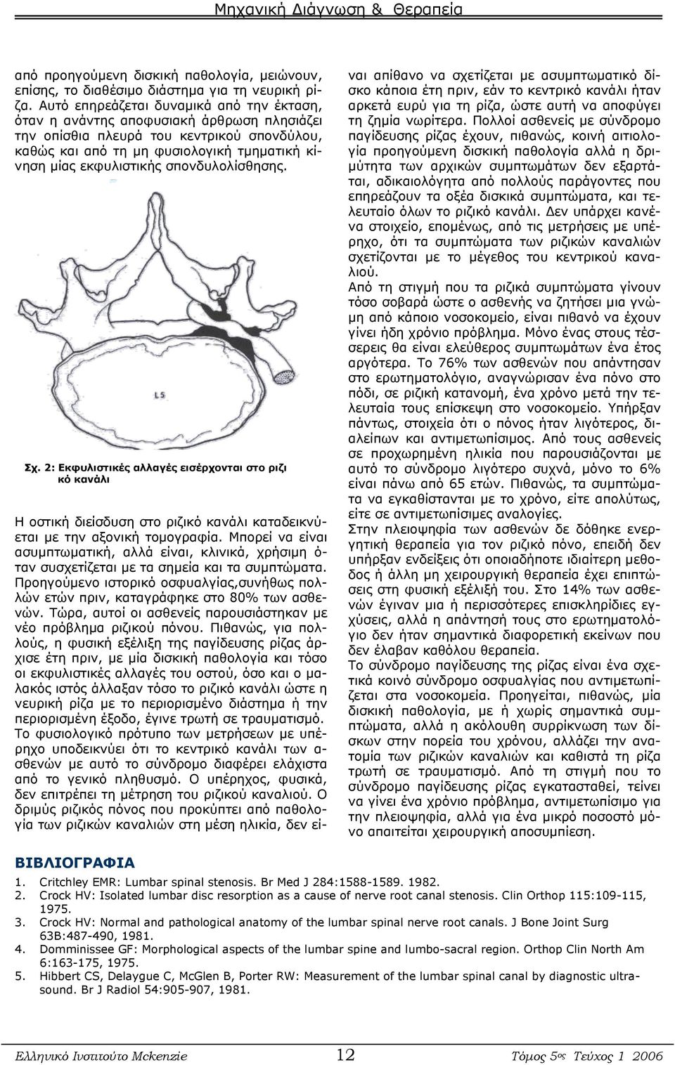 σπονδυλολίσθησης. Σχ. 2: Εκφυλιστικές αλλαγές εισέρχονται στο ριζι κό κανάλι Η οστική διείσδυση στο ριζικό κανάλι καταδεικνύεται με την αξονική τομογραφία.