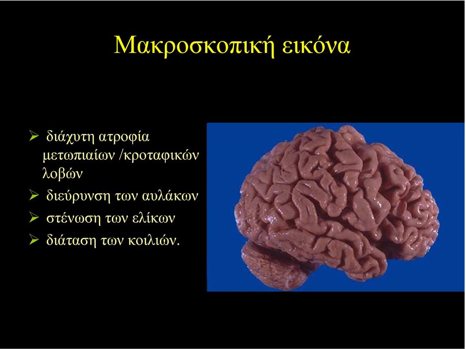 λοβών διεύρυνση των αυλάκων