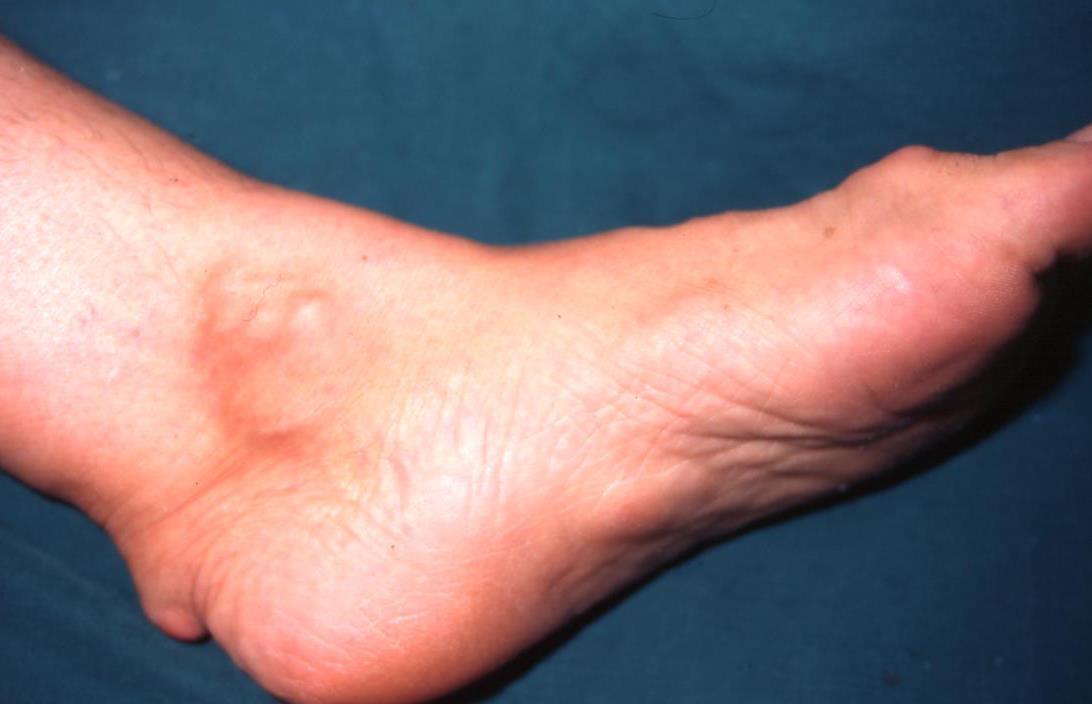 Visible Signs of FH A- Xanthelasma B Corneal arcus (Arcus senilis) C - Achilles