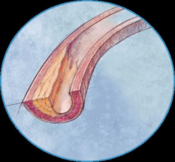 Δράσεις πέραν της μείωσης της ΑΠ ACEIs/ARBs CCBs Mononuclear cell migration Collagen matrix formation Endothelial function Plaque