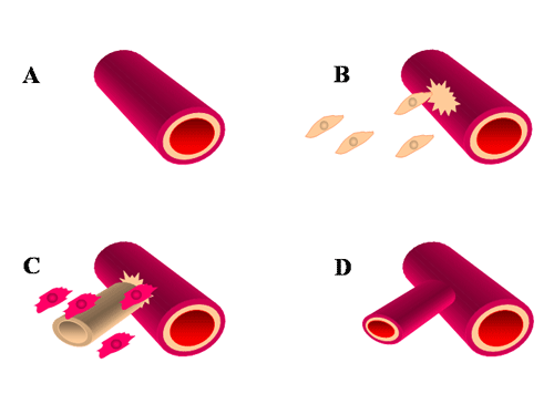 Αγγειογένεση του όγκου Απαραίτητη σε όγκους > 1mm (Gimbrone et al, J Exp Med 1972) για την εξασφάλιση θρεπτικών συστατικών και οξυγόνου Ανάπτυξη κατά μήκος υπαρχόντων αγγείων Η διαδικασία ρυθμίζεται