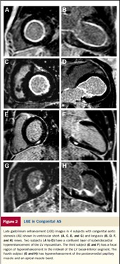 Myocardial ECV in association with