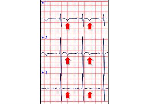 Η μορφολογία των T-wave στις V1-V3