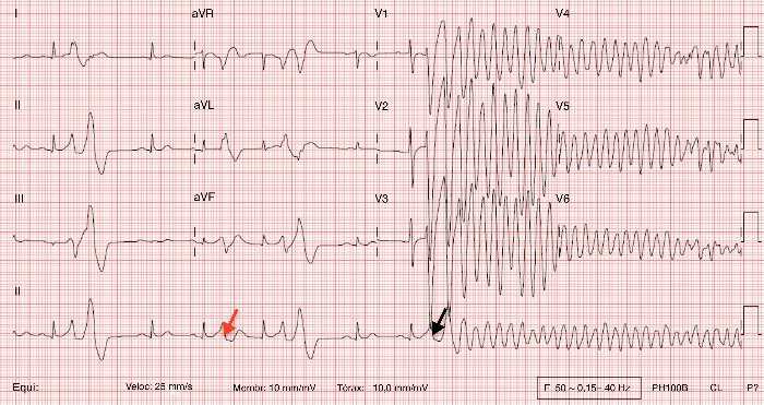 Short QT QTc<360ms/320ms Υπερασβεστιαιμία, υπερκαλιαιμία,