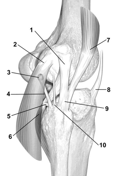 Schematic drawing of major components of posterolateral corner of knee: lateral collateral ligament (1), lateral head of gastrocnemius muscle (2), fabella in lateral head of gastrocnemius tendon (3),
