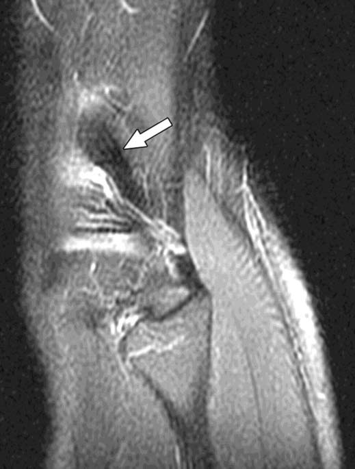 Normal fibular collateral ligament in 21-year-old woman.