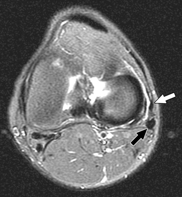 Normal fibular collateral ligament in 21-year-old woman.