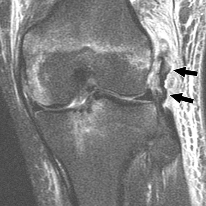 Proximal tear of fibular collateral ligament in 20-year-old man.