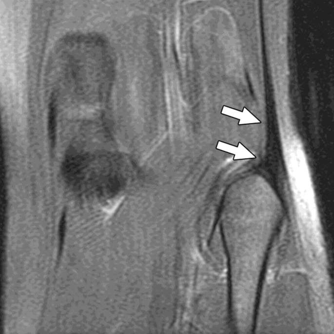 Normal biceps femoris tendon insertion in 19-year-old woman.