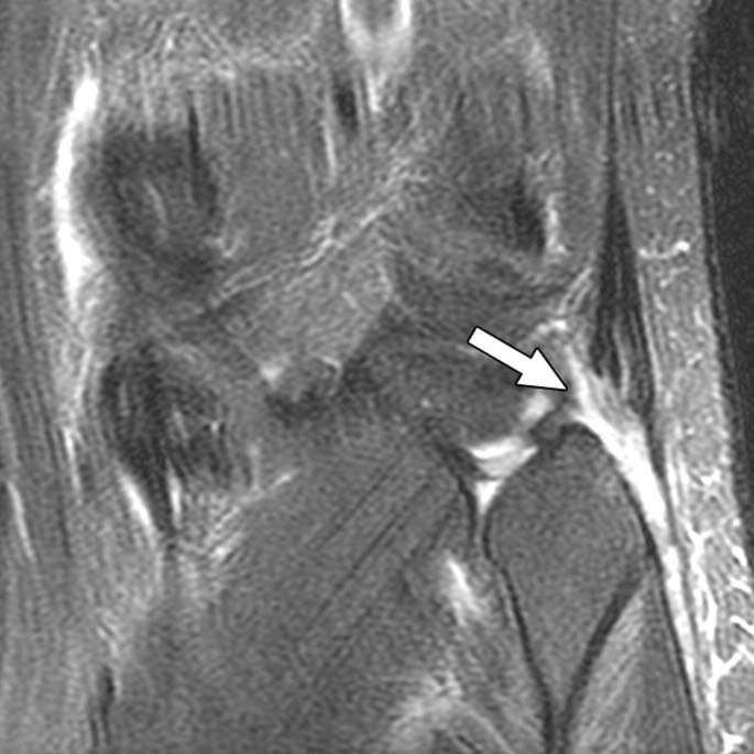 Biceps femoris tendon with tear at insertion in 30-year-old man.