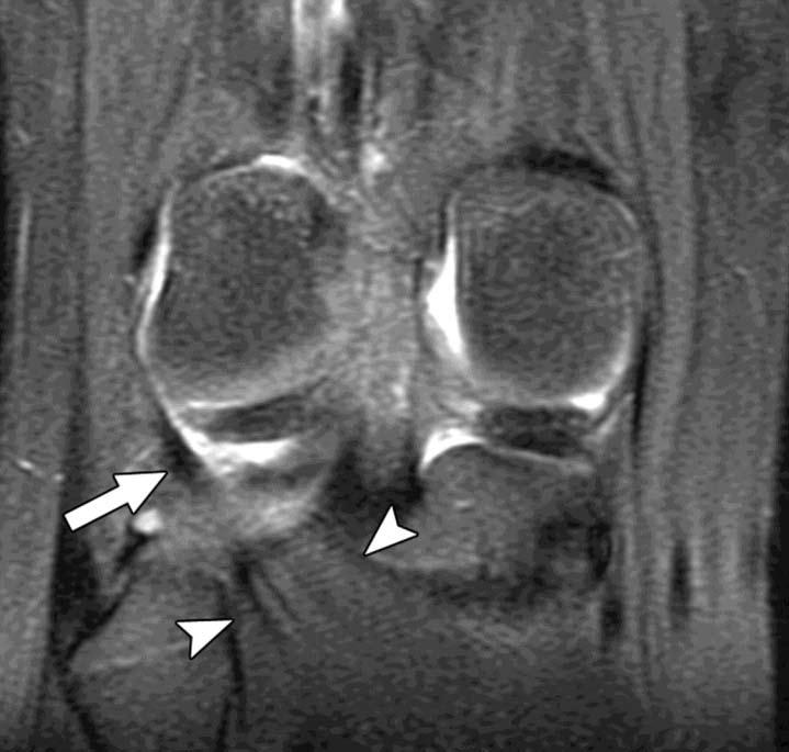 Normal popliteus tendon and muscle in 15-year-old girl.