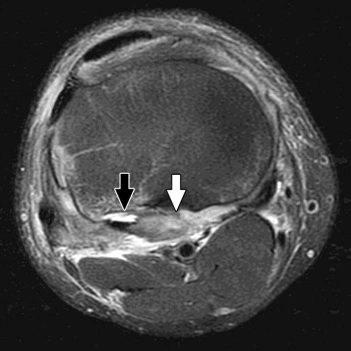 Popliteus injury in 51-year-old man. Vinson E N et al.