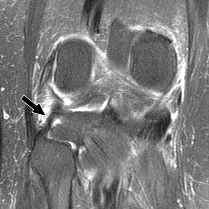 Intact popliteofibular ligament in 75-year-old woman.