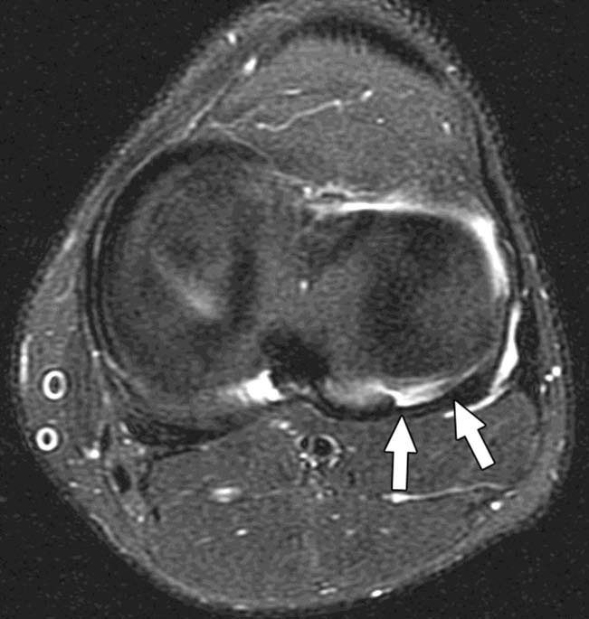 Intact arcuate ligament in 20-year-old man.