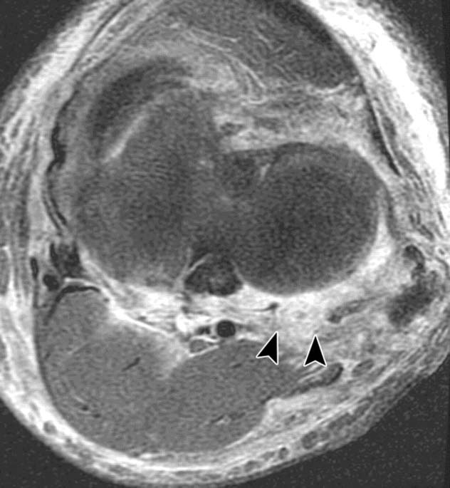 Torn arcuate ligament in 53-year-old man. Vinson E N et al.