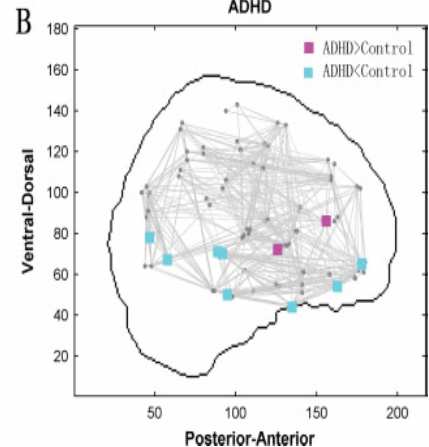 fmri σε κατάσταση ηρεµίας έδειξε µειωµένη ενεργοποίηση σε περιοχές του µέσου προµετωπιαίου, κροταφικού και