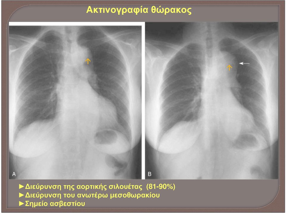 σιλουέτας (81-90%) ιεύρυνση