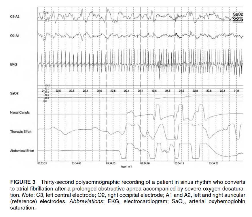 Douglas Bradley. Cardiac Arrhythmias p.