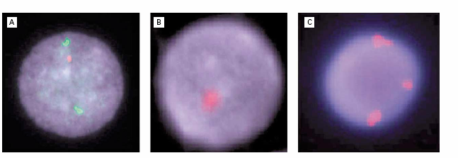 Εικόνα 10 : Κυτταρογενετικές ανωµαλίες που εντοπίζονται µε τη µέθοδο FISH (φθορίζον in situ υβριδισµός) σε ασθενείς µε µυελοδυσπλασία.