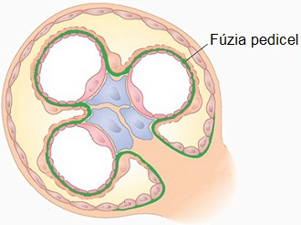 Minimálne abnormality glomerulov Minimálne zmeny glomerulov, Minimal change disease, Lipoidná nefróza, Nilová choroba Dlhé roky patológovia nevideli vo svetelnom mikroskope žiadnu zmenu glomerulov,
