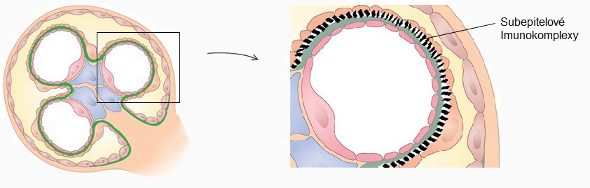 potom hovoríme o difúznom postihnutí. Difúzne postihnuté glomeruly, ale nie sú pri fokálne segmentálnej glomeruloskleróze.