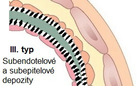 MPGN, Mezangiokapilárna glomerulonefritída Všimnite si, že na všetkých nasledujúcich glomerulonefritídach popisovaných nižšie prebieha na obrázkoch proliferácia, čiže množenie niektorých buniek v