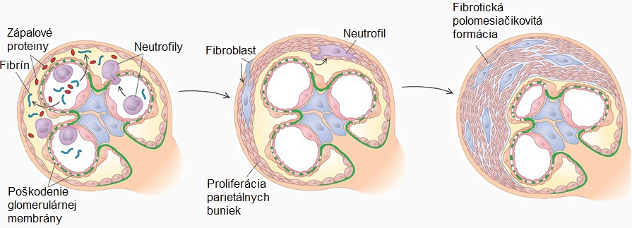 Po infekcii nefritogénnymi streptokokmi, napríklad po angíne môžu v tele vznikať imunokomplexy. Imunokomplexy sú zložené zo streptokokových toxínov a z protilátok.