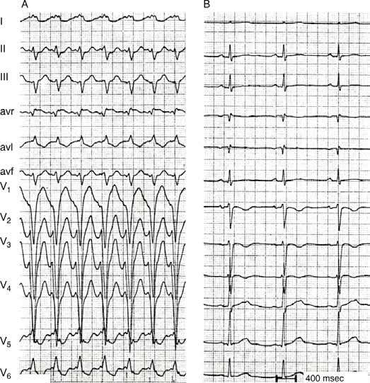 VT in arrhythmogenic (ARVD).