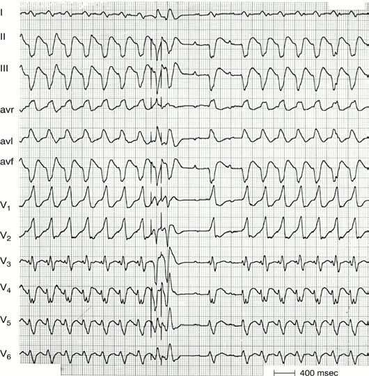 Bundle branch reentry VT. Following two electrically induced premature beats the tachycardia terminates in the middle of the recording.