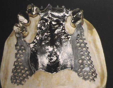 Εικόνα 16.47 Σκελετός από κράμα χρωμίου-κοβαλτίου και στεφάνες από κράμα χρυσού συγκολλημένα και εφαρμοσμένα επάνω στο τελικό εκμαγείο.