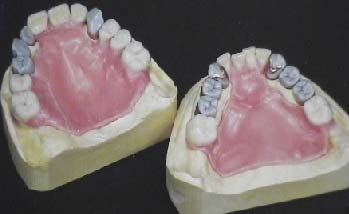 Εικόνα 16.4 Πρώτο διαγνωστικό κέρωμα. 4 Εικόνα 16.5 Τα ακρυλικά δόντια του διαγνωστικού κερώματος μπορούν να συναντηθούν επάνω σε βασικές πλάκες.