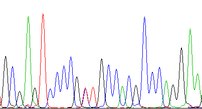 Πίνακας 20. Κλινικά στοιχεία ασθενών φορεών του γενοτύπου Ε167D F479L / V726A στην Κύπρο Table 20.