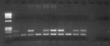 123bp. Προσδιορισµός µετάλλαξης M694I Φχ Ν Μ Ν Μ Ν Μ Ν Μ Ν Μ Ν Μ Ν Μ Ν Μ Ν Μ 174 1 2 4 5 6 3 7 8 9 123bp -- -- 1. Τυφλός Μάρτυρας 2. Φυσιολογικό Δείγμα 3. Φυσιολογικό Δείγμα 4.