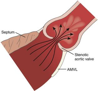 Does Systemic Hypertension Play an Additional Role?