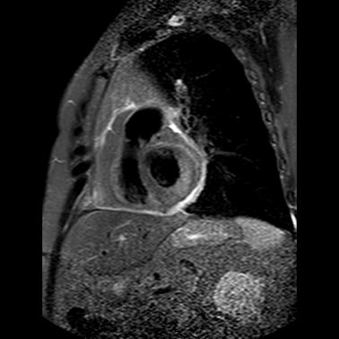 27-9-10: SHORT AXIS STIR.