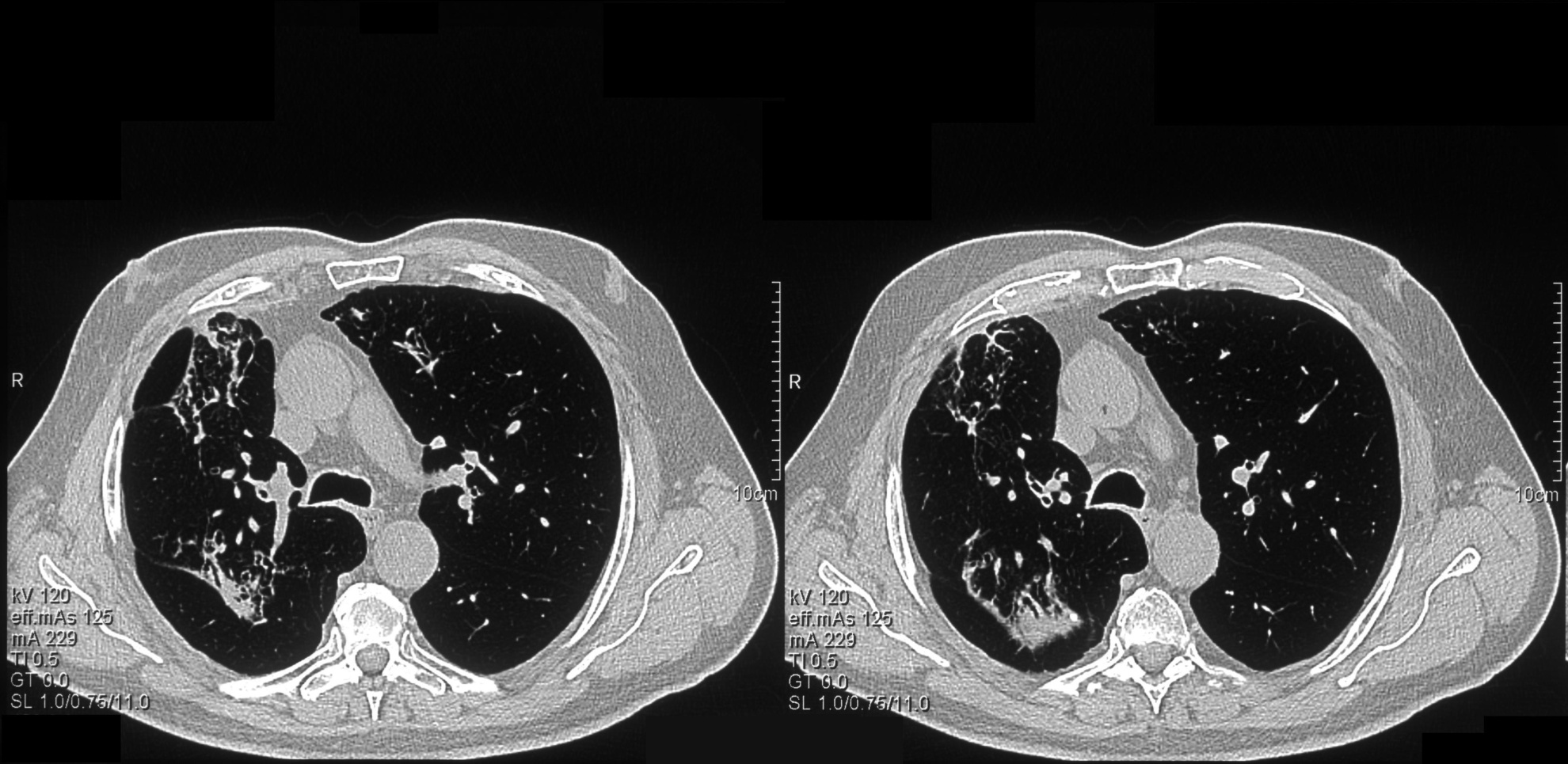 The patient was treated with mycophenolate mofetil and