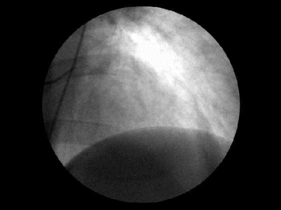 ANGIOGRAM Προσέρχεται στο Αττικό 13 ημέρες