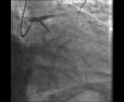 PCI-CX ΑΓΓΕΙΟΠΛΑΣΤΙΚΗ ΣΤΗΝ ΠΕΡΙΣΠΩΜΕΝΗ